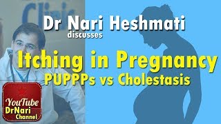 Itching in Pregnancy PUPPPs vs Cholestasis of Pregnancy Discussed by Dr Nari Heshmati [upl. by Idoc]