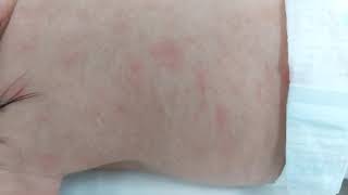 case 399 Erythema toxicum neonatorumEosinophils flea bitten rash  immune inflammatory reaction [upl. by Kippy]