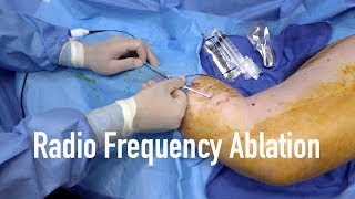 Radio frequency Ablation of Varicose Vein how does it works [upl. by Canning]