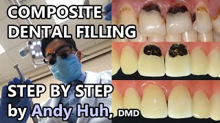 Composite Dental Filling Procedure Steps Toothcolored White 레진 충치 치료 Andy Huh  Evergreen Dental [upl. by Isolt]