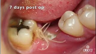 Instructional Video Socket Grafting without Flap Reflection Collagen Sponge Protocol [upl. by Lemrej587]