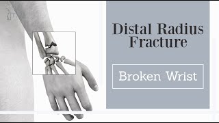 broken wrist  distal radius fractures [upl. by Gordie721]