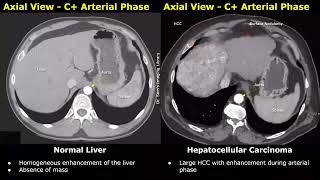 CT Scan Liver Normal Vs Hepatocellular Carcinoma HCC Images  Liver Cancer Imaging Diagnoses [upl. by Trent364]