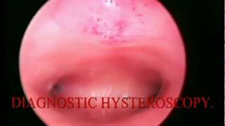 DIAGNOSTIC HYSTEOSCOPY منظار الرحم التشخيصى ED [upl. by Henigman]