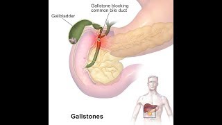 13 DIY Home Remedies for Gallstones [upl. by Driscoll]