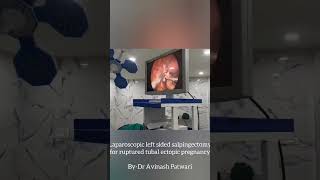 Laparoscopic salpingectomy for rupture ectopic pregnancy gynaecology keyholesurgery [upl. by Nesrac]