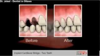 Implants  Implant Cantilever Bridge Two Teeth  Dentist Ottawa [upl. by Eolc531]