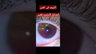 نزيف العين فى الخزانة الأمامية  hyphema [upl. by Winnifred]