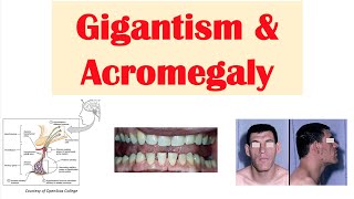 Gigantism amp Acromegaly  Growth Hormone Signs amp Symptoms Diagnosis Treatment [upl. by Axela892]