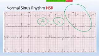 Basic sinus rhythm and ladderdiagram [upl. by Etra]