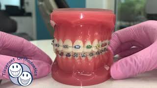 Elastics in Orthodontics  Class 3 [upl. by Nosila]