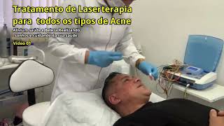 Tratamento de Laserterapia para todos os tipos de Acne [upl. by Nueoht]