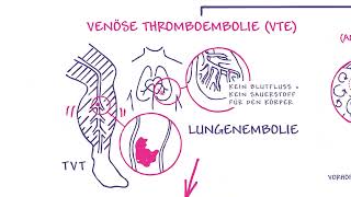 Tiefe VenenThrombose Vorhofflimmern Akutes Koronarsyndrom – Blutgerinnsel und möglichen Folgen [upl. by Tadeo]