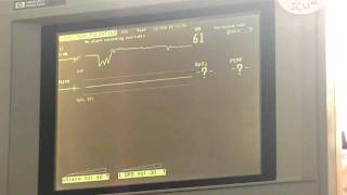 ECG WAVEFORMS [upl. by Corissa]