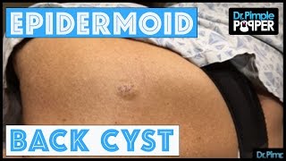 An Epidermoid Cyst Lets cure it with a curette [upl. by Goldina]