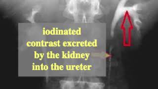 iodinated contrast used for intravenous pyelography IVP [upl. by Arama21]