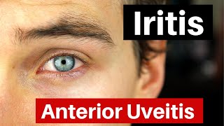 Iritis  What is Anterior Uveitis Doctor Explains [upl. by Kehsihba402]