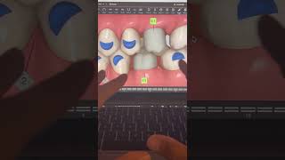 TIP 265  MOLAR STRAIGHTENING amp IMPLANTS [upl. by Yerroc736]