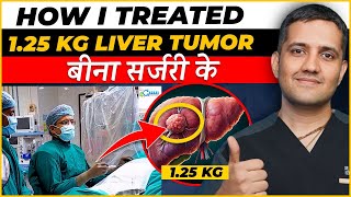 125 kg का liver tumor बिना सर्जरी के कैसे ठीक कर सकते है  No Major Scar  Dr Gaurav Gangwani IR [upl. by Rendrag]