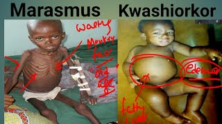 Protein Energy Malnutrition Biochemistry  Marasmus Vs Kwashiorkor  Kwashiorkor  Marasmus [upl. by Selinski167]