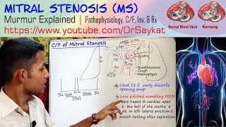 Mitral Stenosis MS  Pathophysiology  Murmur  Clinical Features  Treatment  Dr Saykat [upl. by Hodgkinson]