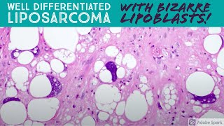 Well differentiated liposarcoma with BIZARRE pleomorphic lipoblasts 5Minute Pathology Pearls [upl. by Goulden176]