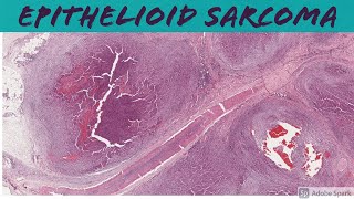 Epithelioid Sarcoma 5Minute Pathology Pearls [upl. by Ferne]