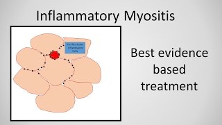 Myositis Inflammatory Myopathy Treatment [upl. by Eudoca]