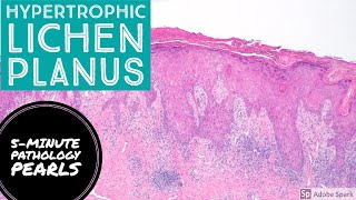 Hypertrophic Lichen Planus 5Minute Pathology Pearls [upl. by Asined617]