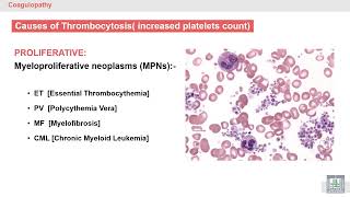 Pathology Hematology  46  Thrombocytosis amp Introduction to Coagulation Disorders [upl. by Assennav75]