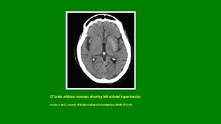 Neurology Quiz 84 Diabetic Striatopathy [upl. by Atined]