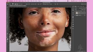 Vitiligo Model Photoshop Retouch [upl. by Etnaled]