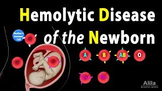 Hemolytic Disease of the Newborn HDN Animation [upl. by Tahp]