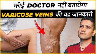 Real Information About Varicose Veins Treatment That No Doctor Will Tell You  Dr Gaurav IR [upl. by Schilit]