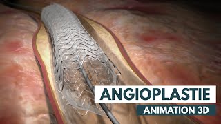 Procédure de l’angioplastie Étape par étape  Animation 3D [upl. by Ettenaj951]