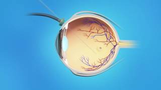 Macular Hole Vitrectomy Surgery [upl. by Hsu]