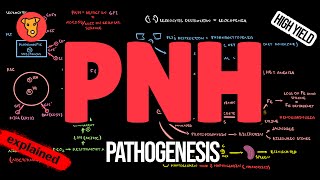 Paroxysmal Nocturnal Hemoglobinuria Pathogenesis Symptoms Diagnosis Treatment [upl. by Ricoriki]