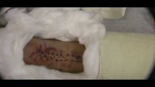 10 Days After Ruptured Achilles Tendon Surgery  Wound Video [upl. by Elga911]