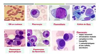 15Gammapathies monoclonales Dysglobulinémies myélome multiple maladie de Waldenström Dr Abbadi [upl. by Ennirok]