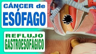 Cáncer de Esófago y Reflujo Gastroesofágico [upl. by Udella]