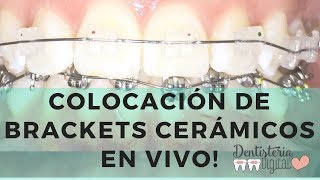 Colocación de Brackets Cerámicos EN VIVO  Ceramic Braces putting on  LIVE [upl. by Case]