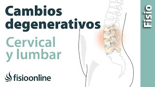 Cambios degenerativos lumbares o cervicales  ¿Qué es [upl. by Alcinia]