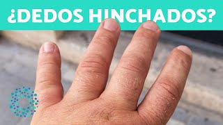 ¿Por qué se HINCHAN los DEDOS de las MANOS 10 Motivos 🖐️ ¿Cómo Desinflamar Manos Hinchadas [upl. by Elva180]