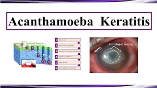 Acanthamoeba Keratitis [upl. by Christan]