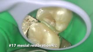 26 partial pulpectomy amp 27 proximal occlusal resin restoration [upl. by Neleb]