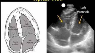 How to Echocardiography  Subxiphoid View [upl. by Latonia771]