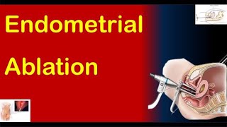 Endometrial Ablation Types Procedure Recovery amp Complications [upl. by Noedig]