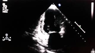 Echocardiogram  akinesia of the inferior wall [upl. by Mcguire]