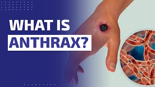 WHAT IS ANTHRAX [upl. by Bate]