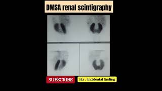 Diagnosis  DMSA renal scintigraphy  Practical Case  Radiology [upl. by Zita]